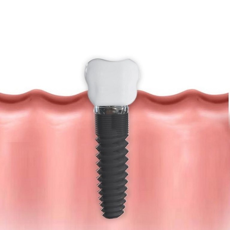 dental-implants-1636565-1280×1280