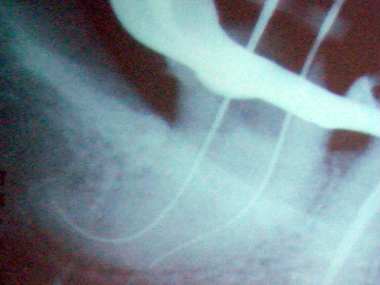 endo-x22